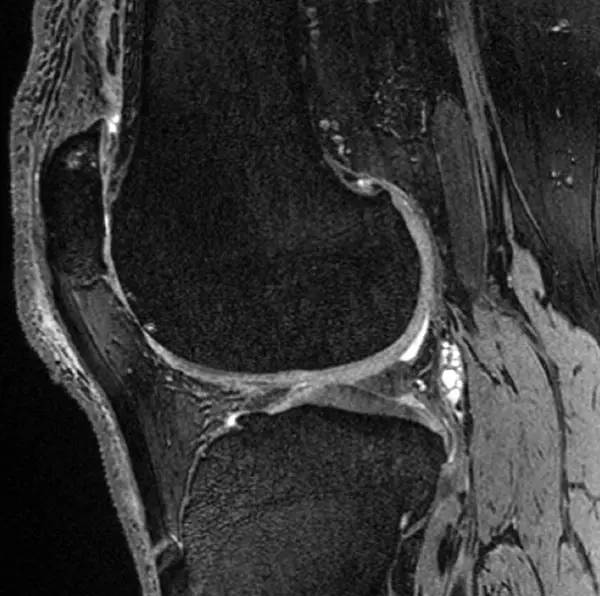 Scan of cross-section of a knee with bones, muscles and ligaments
