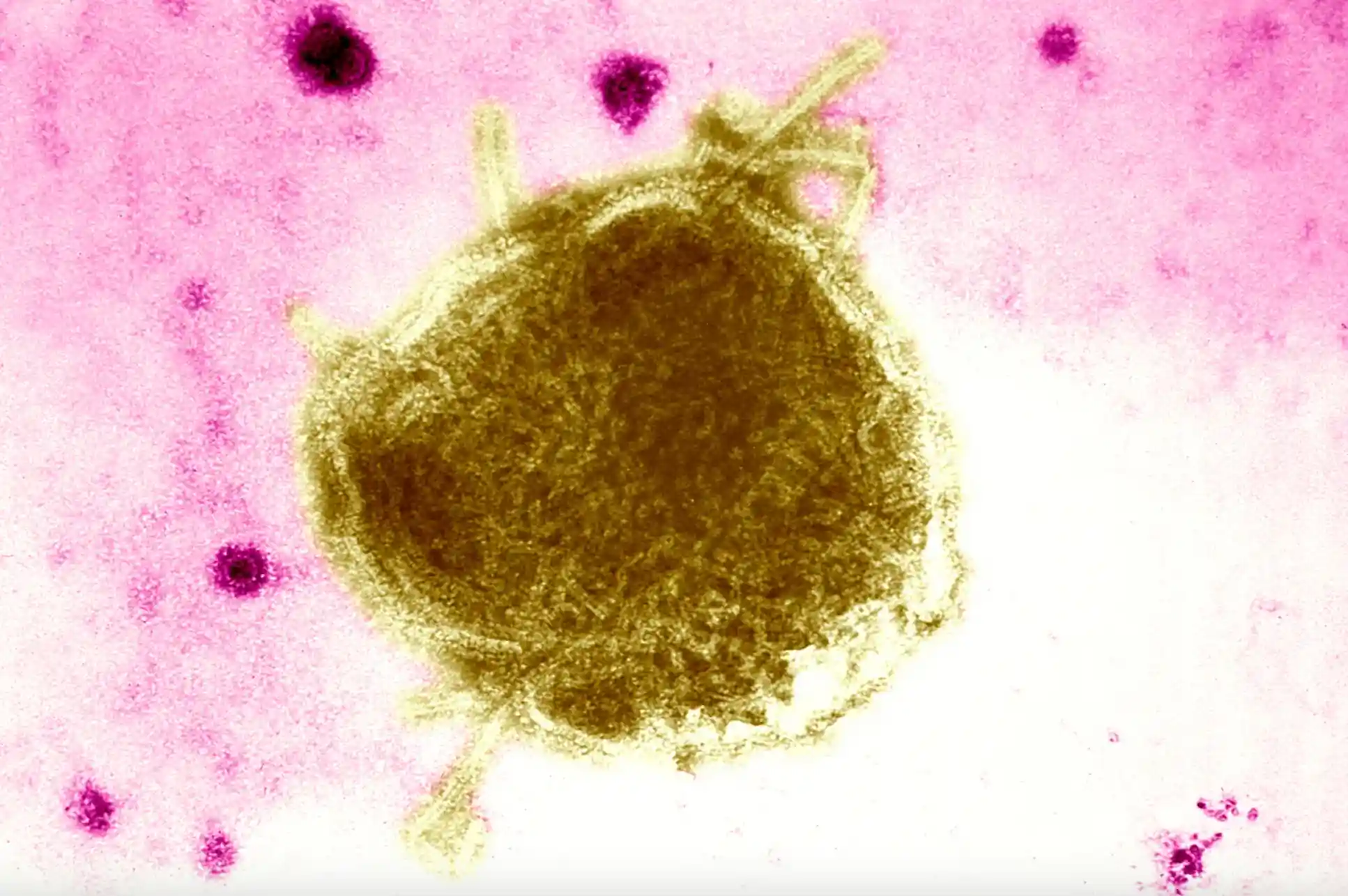 A measles outbreak in a rural Texas county is raising alarm among those in the public health community. Photo By BSIP/UIG Via Getty Images
