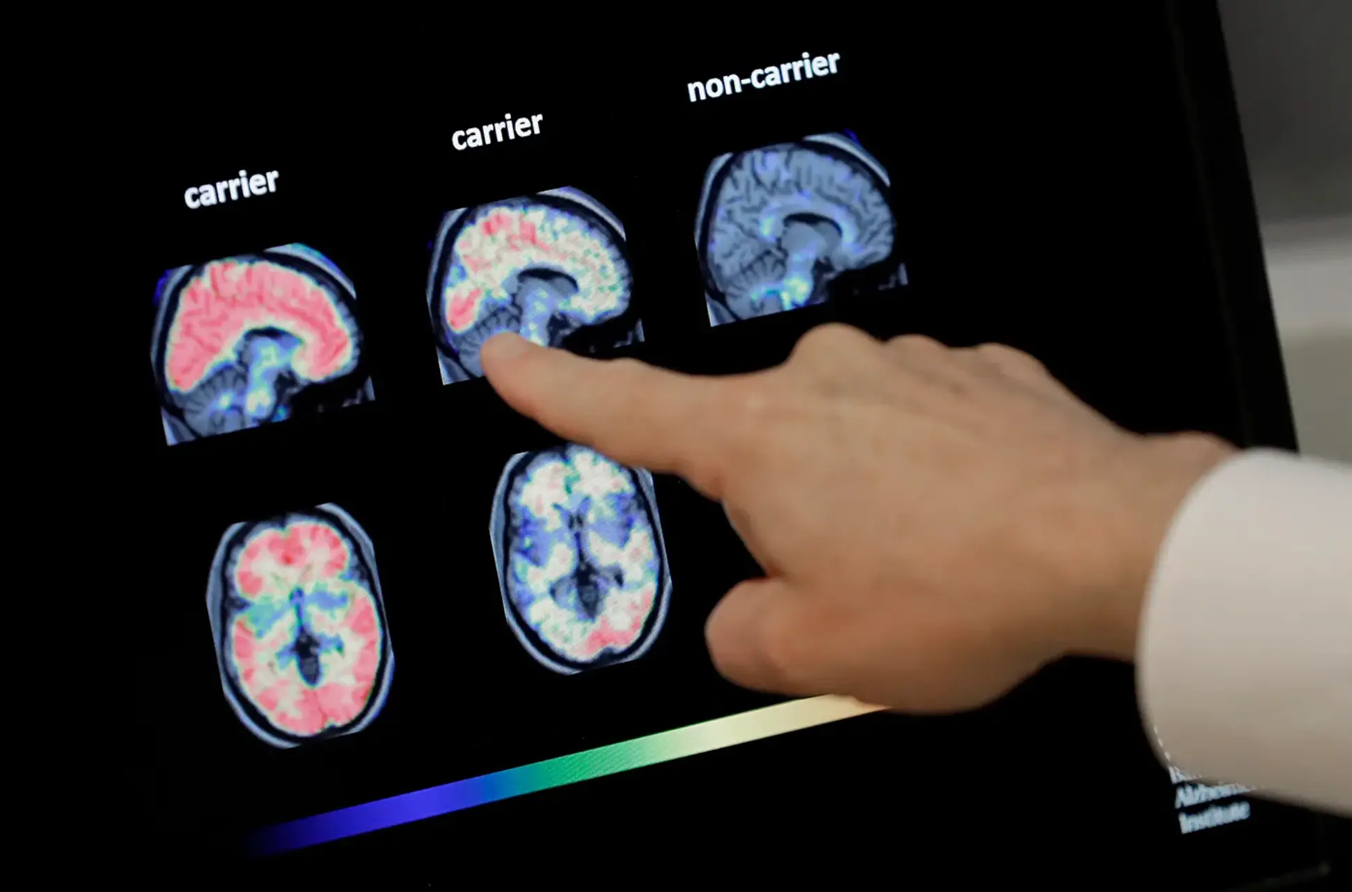 A doctor looks at PET brain scans which were previously used to help diagnose Alzheimer’s disease. (AP Photo/Matt York, File)