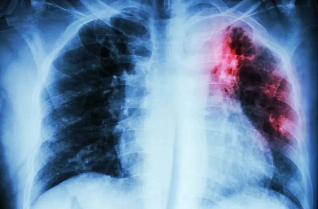 Photo of lungs damaged by tuberculosis